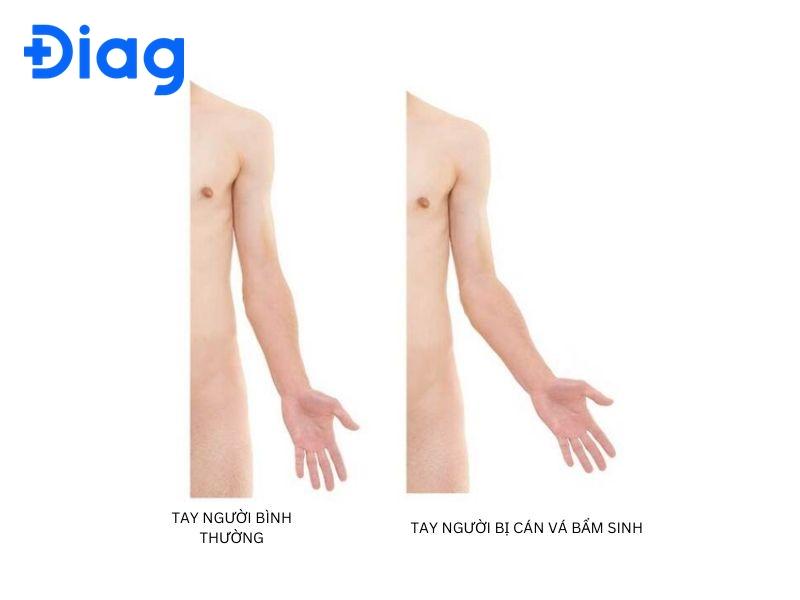 cánh tay bị cong - Image 2