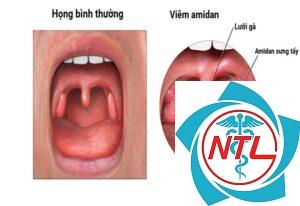 cắt amidan có đau không