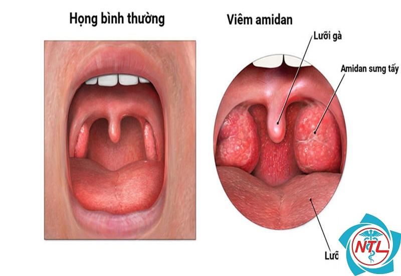 cắt amidan có đau không - Image 1