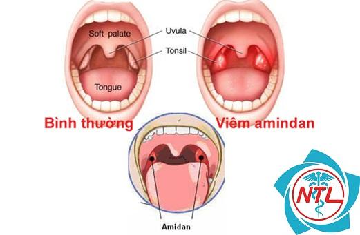 cắt amidan có sao không - Image 4