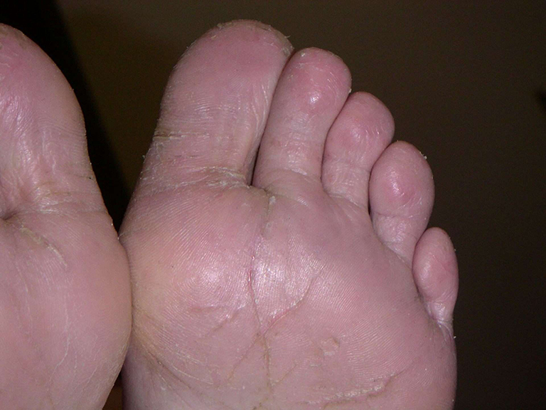 chàm chân - Image 5