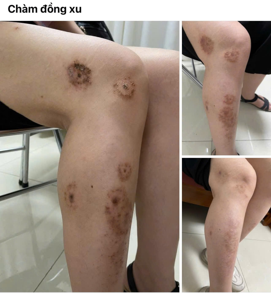chàm đồng tiền