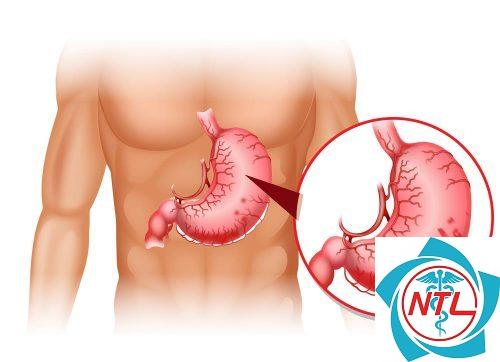 chăm sóc bệnh nhân xuất huyết tiêu hóa - Image 4