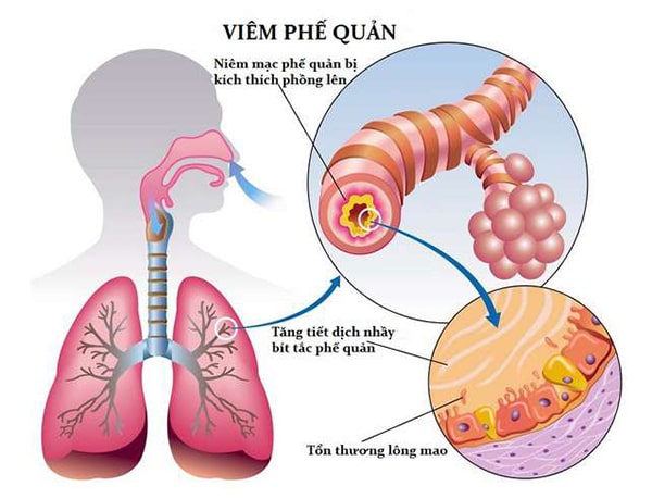 chăm sóc người bệnh viêm phế quản - Image 4