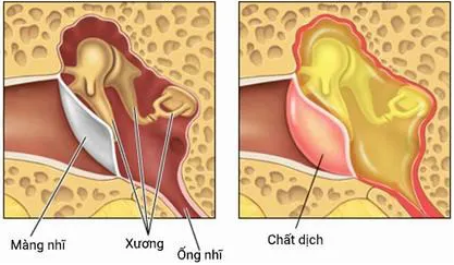chăm sóc trẻ viêm tai giữa - Image 3