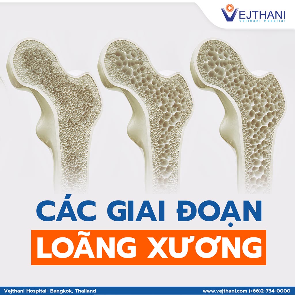 chẩn đoán loãng xương - Image 4
