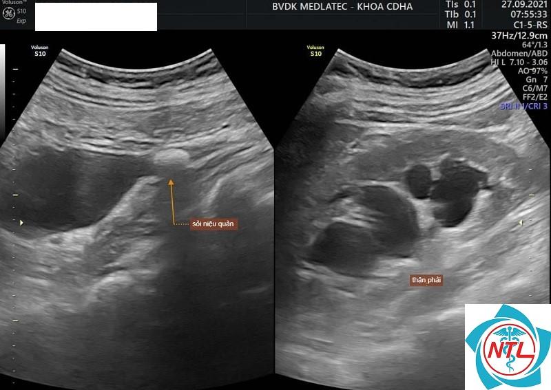 chẩn đoán xác định sỏi niệu quản - Image 4