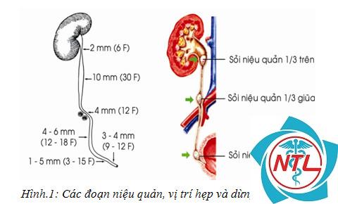 chẩn đoán xác định sỏi niệu quản