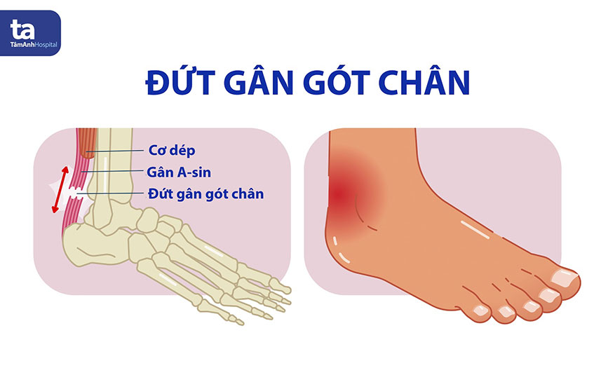chấn thương gót chân - Image 1