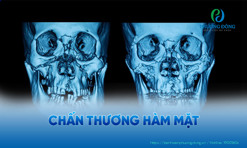 chấn thương hàm mặt - Image 2