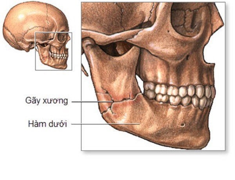 chấn thương hàm mặt - Image 3