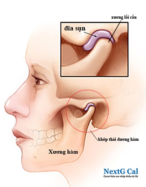 chấn thương quai hàm