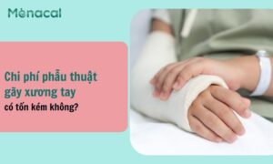 chi phí bó bột tay