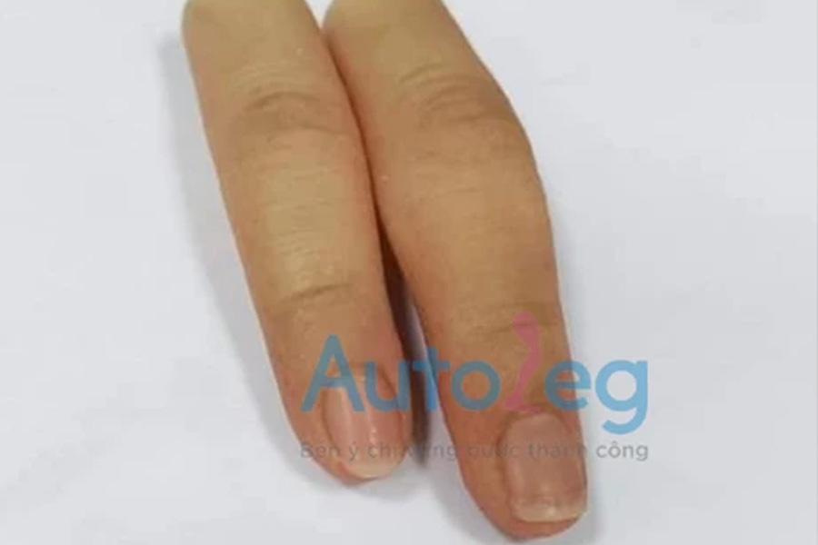 chi phí phẫu thuật chỉnh hình ngón tay - Image 3