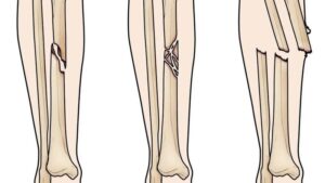chi phí phẫu thuật gãy xương cẳng chân