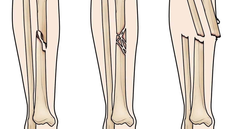 chi phí phẫu thuật gãy xương cẳng chân