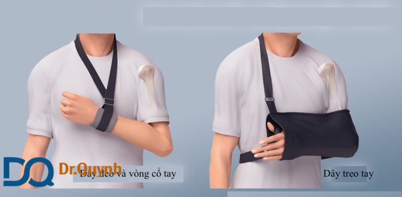 chi phí phẫu thuật gãy xương cánh tay - Image 2