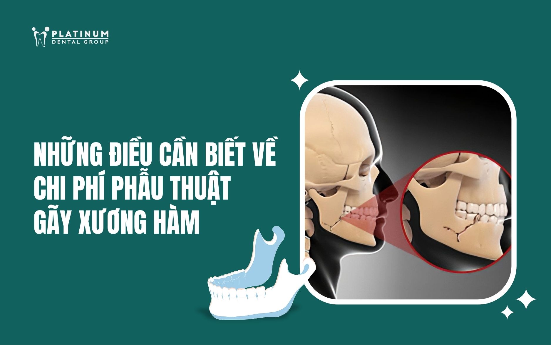 chi phí phẫu thuật gãy xương hàm - Image 3