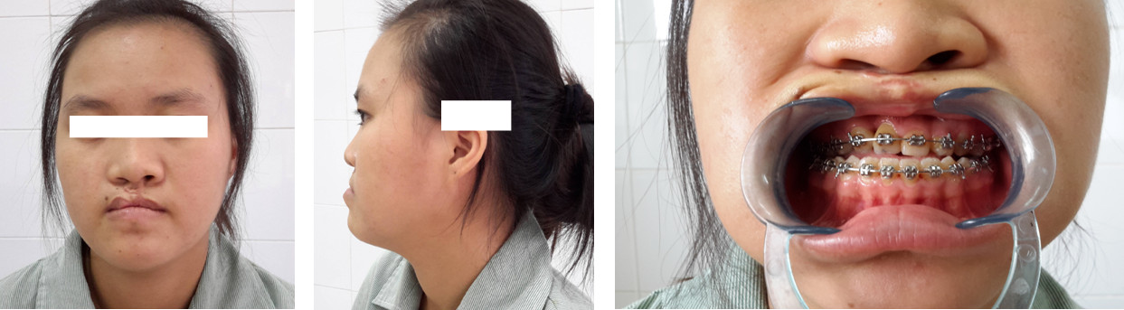 chinh xuong ham - Image 4