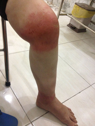 chỗ gãy xương bị sưng - Image 3