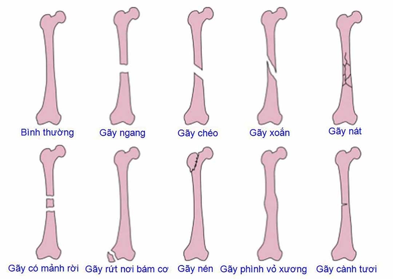 chỗ gãy xương bị sưng - Image 5