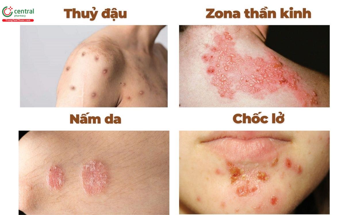 chốc lở - Image 2