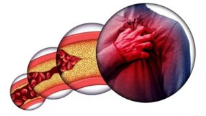 cholesterol cao ở người cao tuổi