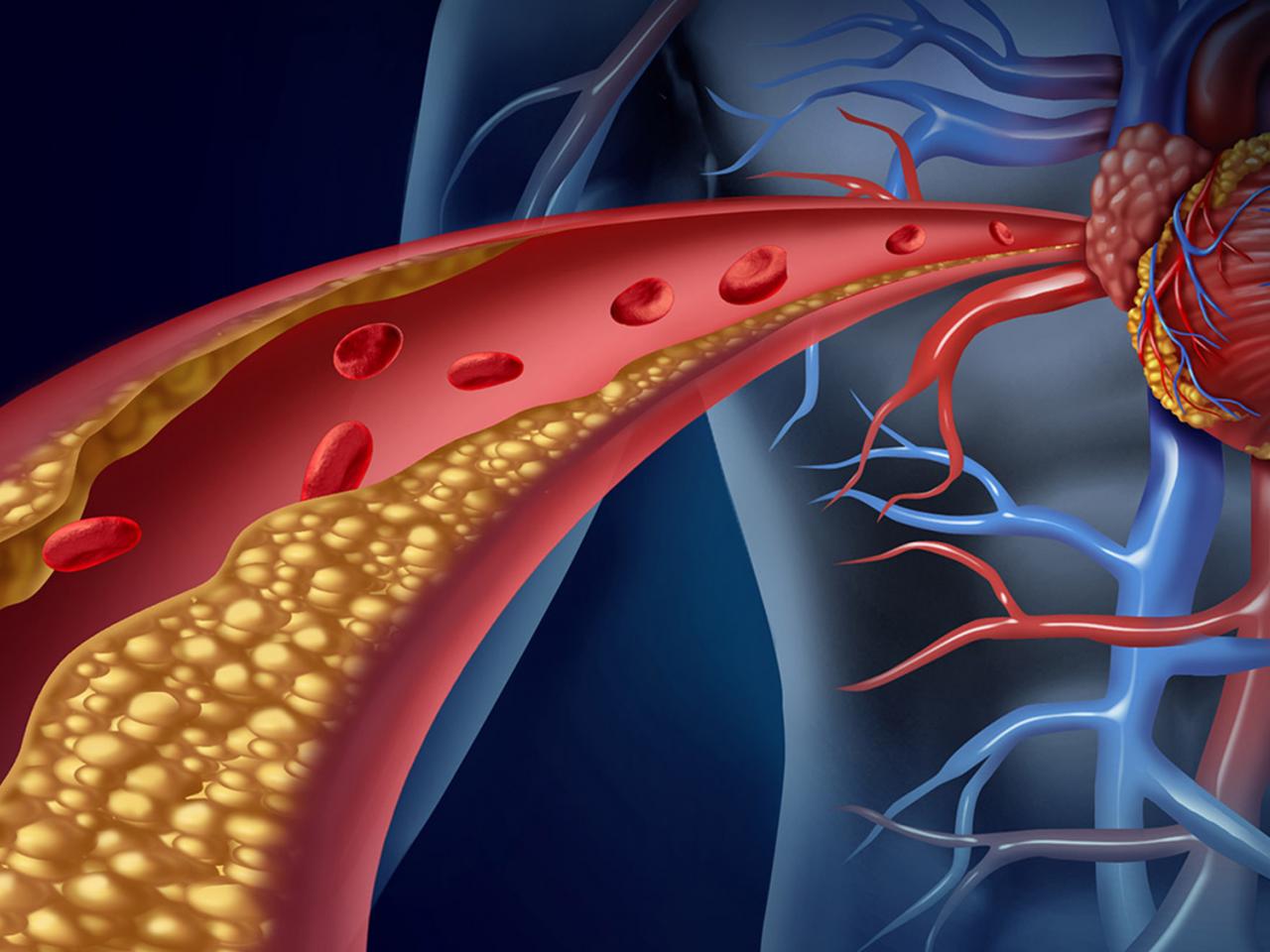 cholesterol cao ở người lớn - Image 2