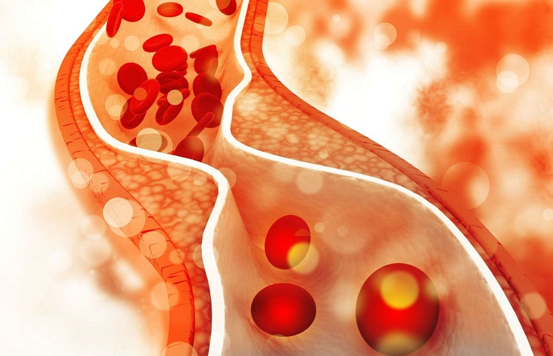 cholesterol cao ở người lớn - Image 3