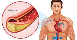 cholesterol cao ở người lớn