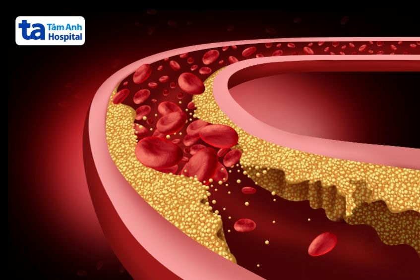 cholesterol cao ở người lớn - Image 4