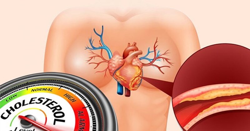 cholesterol cao ở người lớn - Image 5