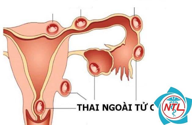 chửa ngoài dạ con có bị cắt buồng trứng không - Image 2