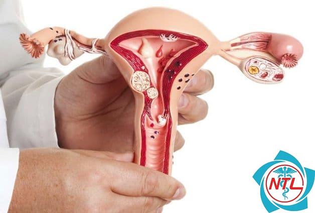 chửa ngoài dạ con có bị cắt buồng trứng không - Image 3