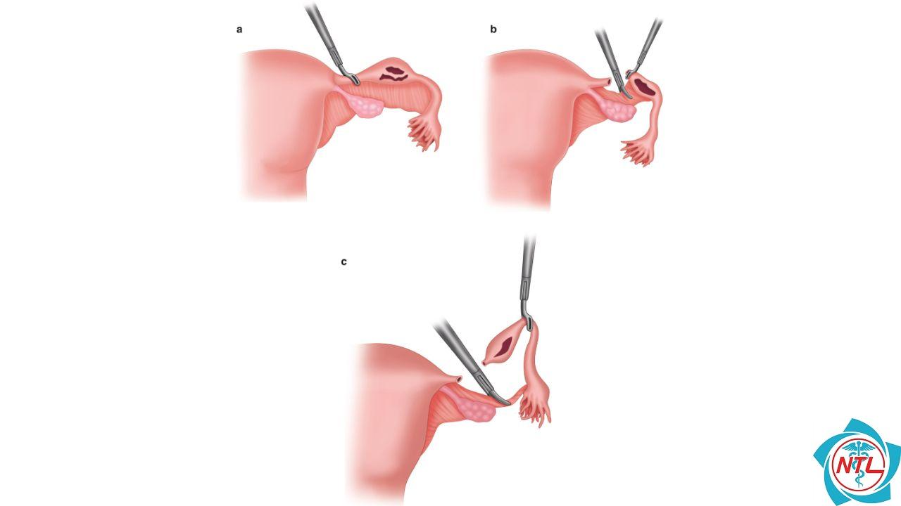 chửa ngoài dạ con có bị cắt buồng trứng không - Image 4