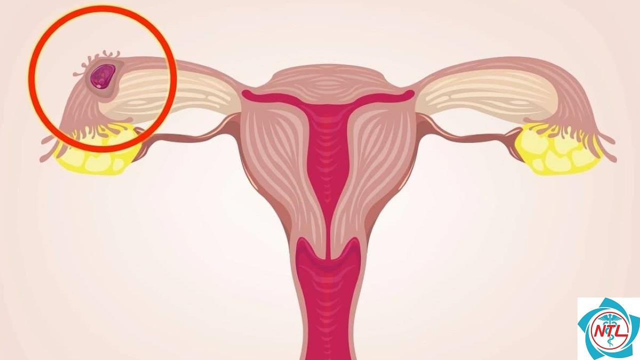 chửa ngoài dạ con có bị cắt buồng trứng không - Image 1