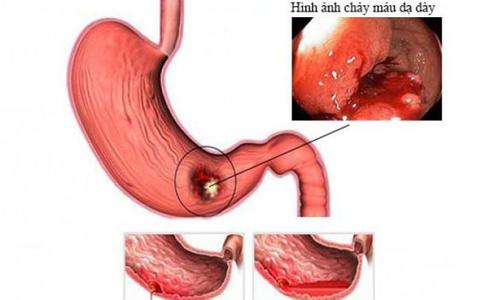 chướng bụng kèm tiêu chảy - Image 3