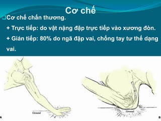 cơ chế gãy xương đòn