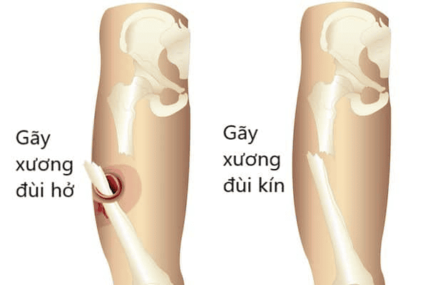 co dinh gay xuong dui kin - Image 2