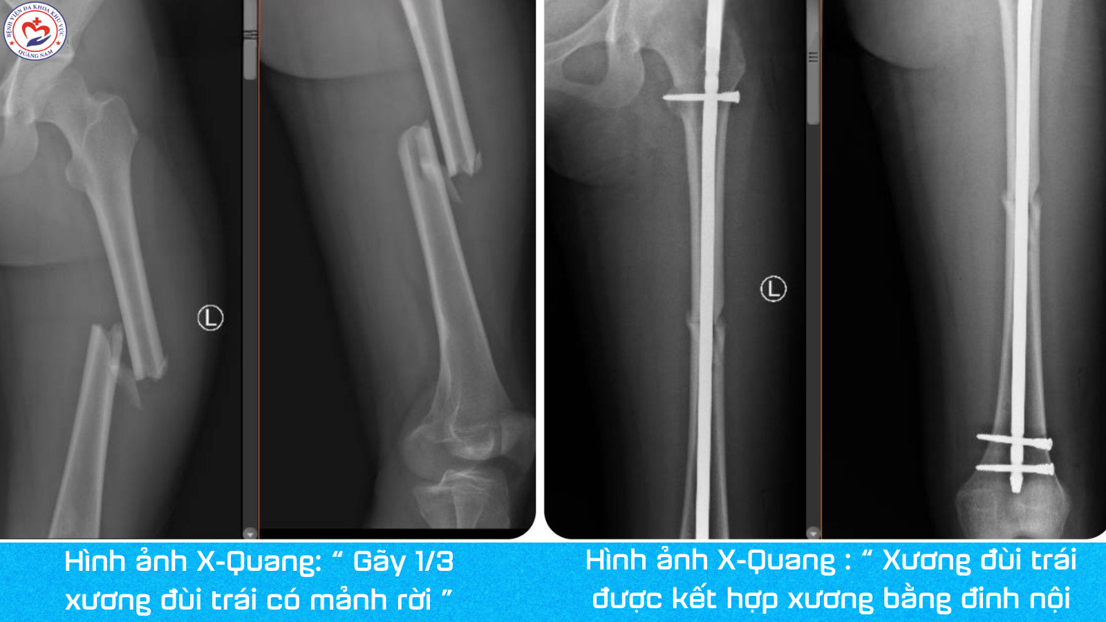 co dinh gay xuong dui kin - Image 3