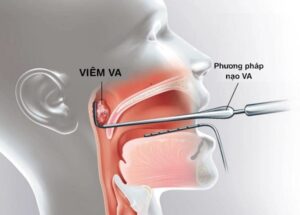 có nên nạo va cho trẻ