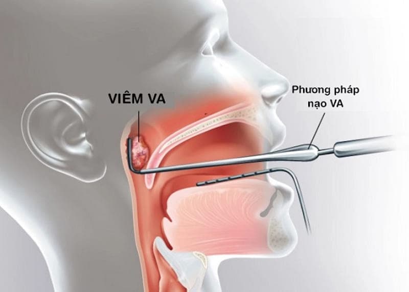 có nên nạo va cho trẻ