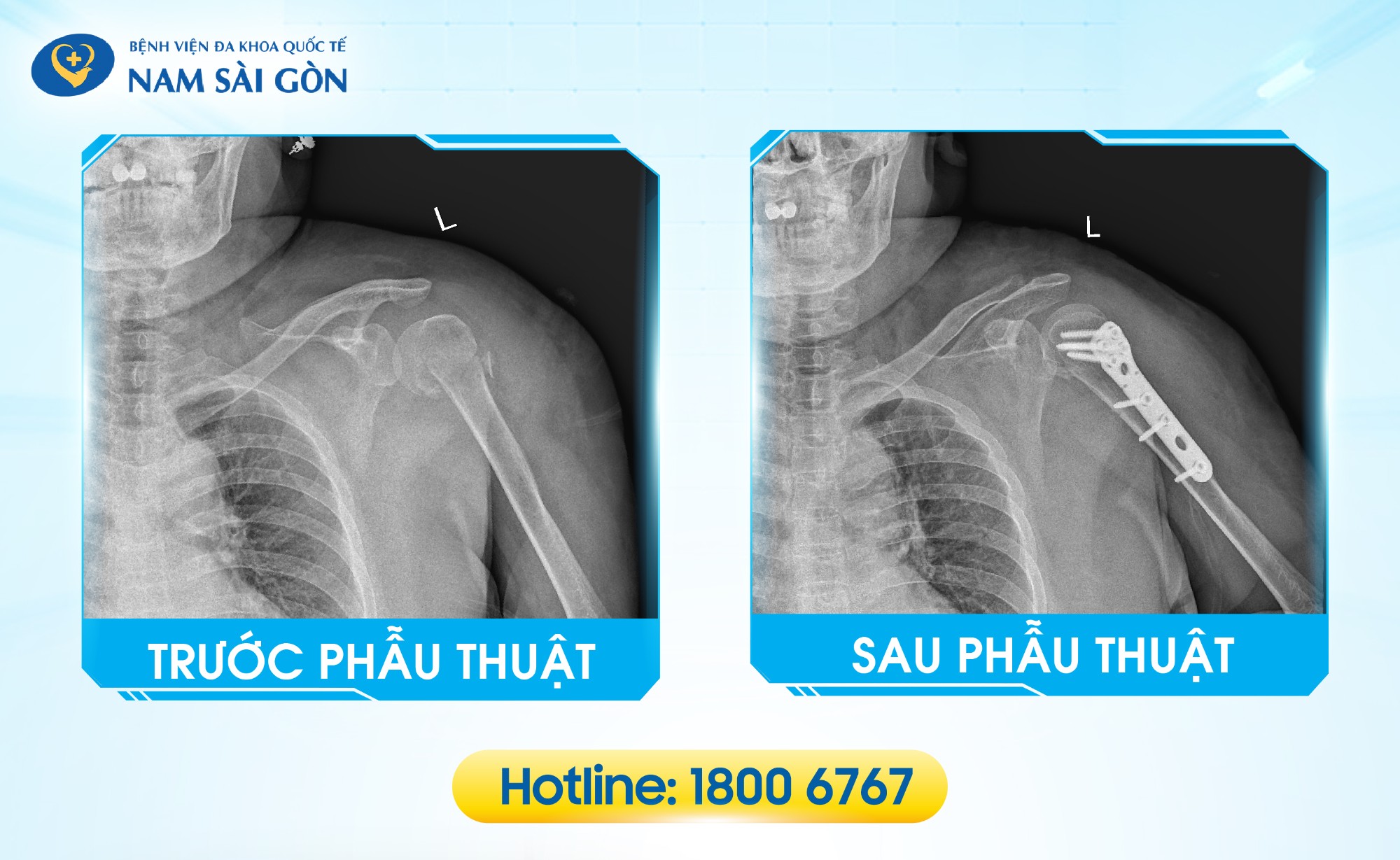 cổ phẫu thuật xương cánh tay - Image 4