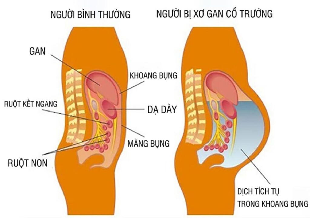 cổ trướng do xơ gan