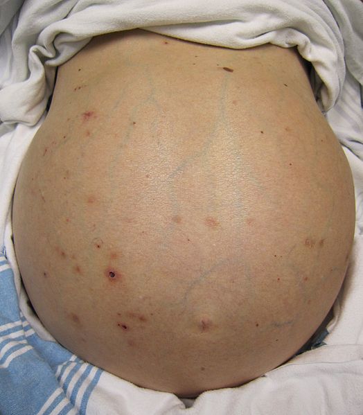 cổ trướng do xơ gan - Image 2