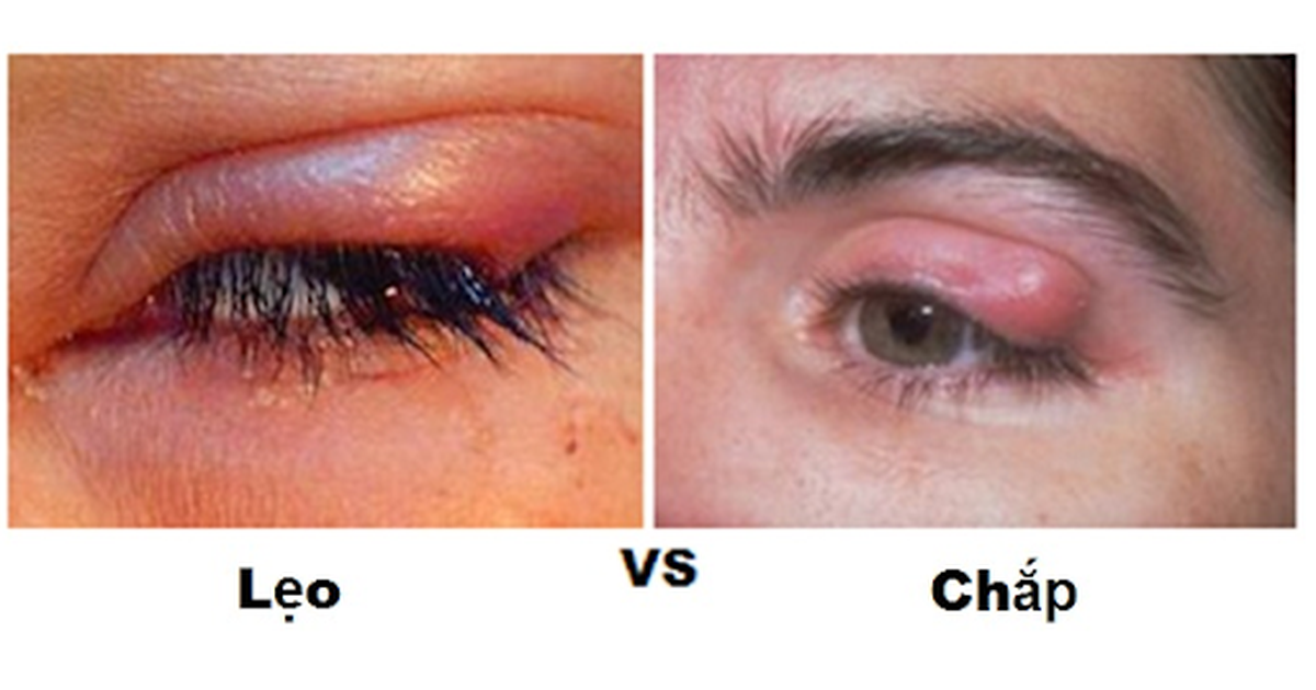 cộm mắt - Image 3