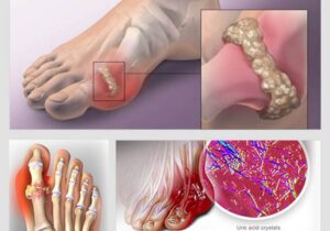 cơn gout cấp