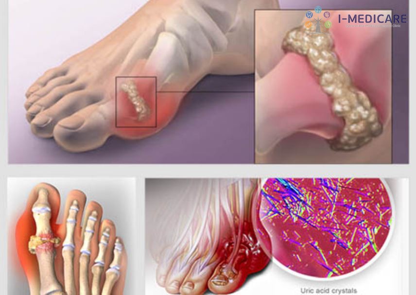 cơn gout về đêm