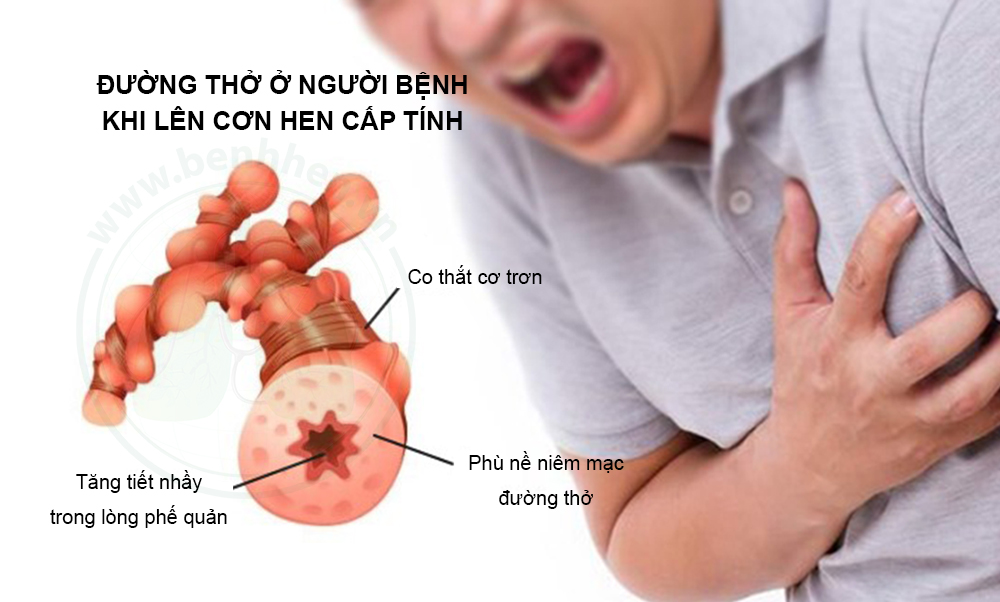 cơn hen phế quản khi thay đổi thời tiết - Image 2