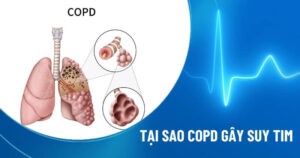 copd kèm suy tim
